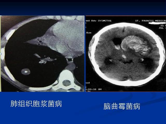 金迪克获得发明专利授权：“一种肺炎球菌荚膜多糖的纯化方法”